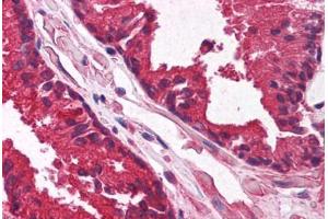 Human Prostate (formalin-fixed, paraffin-embedded) stained with KLF6 antibody ABIN214122 at 5 ug/ml followed by biotinylated goat anti-rabbit IgG secondary antibody ABIN481713, alkaline phosphatase-streptavidin and chromogen. (KLF6 antibody  (AA 155-204))