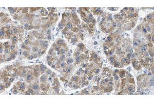 ABIN6269344 at 1/100 staining Human liver cancer tissue by IHC-P.