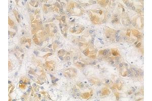 ABIN6265548 and ABIN6266642 at 1/100 staining human renal cell carcinoma by IHC-P.