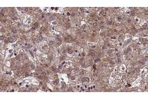ABIN6273969 at 1/100 staining Human liver cancer tissue by IHC-P.