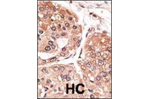Formalin-fixed and paraffin-embedded human cancer tissue reacted with the primary antibody, which was peroxidase-conjugated to the secondary antibody, followed by DAB staining. (SMYD5 antibody  (C-Term))