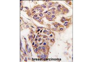 Formalin-fixed and paraffin-embedded human breast carcinoma tissue reacted with C8orf32 antibody , which was peroxidase-conjugated to the secondary antibody, followed by DAB staining. (WDYHV1 antibody  (AA 106-136))