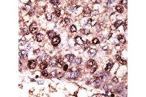 IHC analysis of FFPE human hepatocarcinoma tissue stained with the SIRT7 antibody (SIRT7 antibody  (AA 331-360))