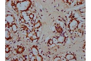 IHC image of ABIN7155703 diluted at 1:300 and staining in paraffin-embedded human breast cancer performed on a Leica BondTM system. (HMX2 antibody  (AA 1-150))