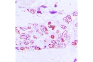 Immunohistochemical analysis of GSK3 alpha/beta (pY279/216) staining in human lung cancer formalin fixed paraffin embedded tissue section. (GSK3 alpha/beta antibody  (pTyr216, pTyr279))