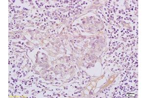 Formalin-fixed and paraffin embedded human lymphoma tissue labeled with Anti-AFAP/AFAP-110 Polyclonal Antibody, Unconjugated (ABIN1387171) at 1:200 followed by conjugation to the secondary antibody (AFAP antibody  (AA 286-325))