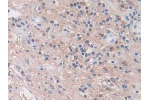 Detection of MMP3 in Human Appendix Tissue using Monoclonal Antibody to Matrix Metalloproteinase 3 (MMP3) (MMP3 antibody  (AA 363-477))