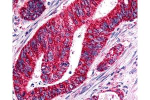 Anti-BOB / GPR15 antibody IHC of human Colon, Carcinoma. (GPR15 antibody  (Cytoplasmic Domain))