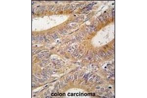 Formalin-fixed and paraffin-embedded human colon carcinoma tissue reacted with AIK antibody (N-term) (ABIN392389 and ABIN2842017) , which was peroxidase-conjugated to the secondary antibody, followed by DAB staining. (Aurora A antibody  (N-Term))