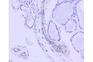Immunohistochemistry of paraffin-embedded human thyroid using ROCK1 antibody (ABIN5997107) at dilution of 1/100 (40x lens). (ROCK1 antibody)