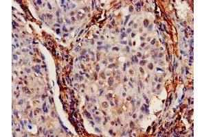IHC image of ABIN7156683 diluted at 1:700 and staining in paraffin-embedded human lung cancer performed on a Leica BondTM system.