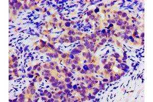 Immunohistochemistry of paraffin-embedded human pancreatic cancer using ABIN7146350 at dilution of 1:100 (SLC25A12 antibody  (AA 202-317))