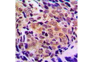 Immunohistochemical analysis of Histone Deacetylase 5/9 staining in human prostate cancer formalin fixed paraffin embedded tissue section. (HDAC5/9 antibody  (Center))