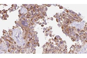 ABIN6273218 at 1/100 staining Human Melanoma tissue by IHC-P. (CTHRC1 antibody  (Internal Region))