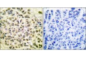 Immunohistochemistry analysis of paraffin-embedded human breast carcinoma, using C/EBP-beta (Phospho-Thr235/188) Antibody. (CEBPB antibody  (pThr235))