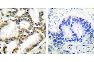 Peptide - +Immunohistochemical analysis of paraffin-embedded human lung carcinoma tissue using DJ-1 antibody (#C0172). (PARK7/DJ1 antibody)