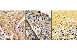 Formalin-fixed and paraffin-embedded (from Left to Right) human hepatocarcinoma, lung carcinoma and cerebellum reacted with GARP Antibody (Center), which was peroxidase-conjugated to the secondary antibody, followed by DAB staining. (LRRC32 antibody  (AA 240-269))