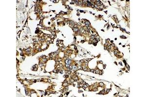 IHC-P: HNF6 antibody testing of human liver cancer tissue (ONECUT1 antibody  (N-Term))