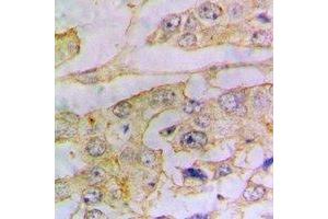 Immunohistochemical analysis of Ferritin L staining in human lung cancer formalin fixed paraffin embedded tissue section. (Ferritin L antibody)