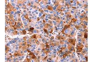 The image on the left is immunohistochemistry of paraffin-embedded Human liver cancer tissue using ABIN7190588(ERN2 Antibody) at dilution 1/40, on the right is treated with synthetic peptide.