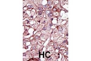 Formalin-fixed and paraffin-embedded human hepatocellular carcinoma tissue reacted with ACVRL1 polyclonal antibody  , which was peroxidase-conjugated to the secondary antibody, followed by DAB staining. (ACVRL1 antibody  (N-Term))