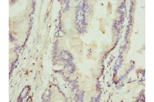 Immunohistochemistry of paraffin-embedded human prostate cancer using ABIN7168074 at dilution of 1:100 (Rhotekin antibody  (AA 304-563))