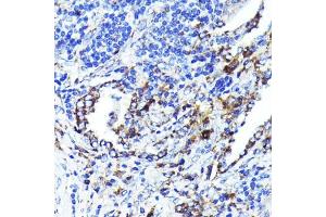 Immunohistochemistry of paraffin-embedded human lung cancer using CD9 Rabbit mAb (ABIN7266227) at dilution of 1:100 (40x lens). (CD9 antibody)