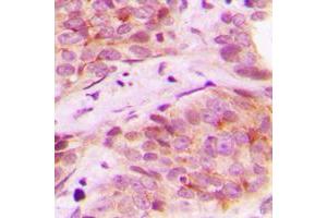 Immunohistochemical analysis of Mammaglobin B staining in human breast cancer formalin fixed paraffin embedded tissue section. (SCGB2A1 antibody  (N-Term))