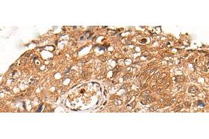 Immunohistochemistry of paraffin-embedded Human lung cancer tissue using KLHL36 Polyclonal Antibody at dilution of 1:55(x200) (KLHL36 antibody)