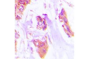 Immunohistochemical analysis of Cardiotrophin-1 staining in human lung cancer formalin fixed paraffin embedded tissue section. (Cardiotrophin 1 antibody  (N-Term))