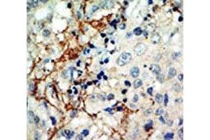IHC analysis of FFPE human breast carcinoma tissue stained with the EphA3 antibody (EPH Receptor A3 antibody  (AA 115-144))