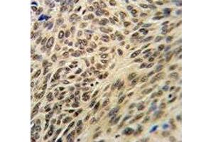 XRCC6 antibody IHC analysis in formalin fixed and paraffin embedded human lung carcinoma. (XRCC6 antibody  (AA 521-548))
