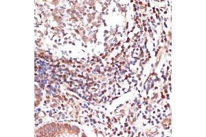 Immunohistochemistry of paraffin-embedded human appendix using  Rabbit mAb (ABIN3016894, ABIN3016895, ABIN3016896, ABIN1679361 and ABIN1679362) at dilution of 1:100 (40x lens). (ALOX5 antibody)