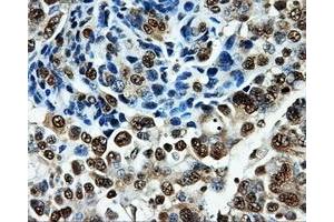 Immunohistochemical staining of paraffin-embedded Adenocarcinoma of breast tissue using anti-PKMYT1 mouse monoclonal antibody.