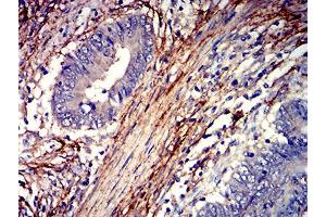 Immunohistochemical analysis of paraffin-embedded rectum cancer tissues using F2R mouse mAb with DAB staining. (PAR1 antibody  (AA 42-176))