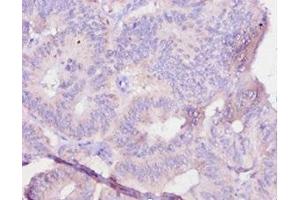 Immunohistochemistry of paraffin-embedded human colon cancer using ABIN7179323 at dilution of 1:10 (IL12B antibody  (AA 23-327))