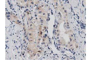 Immunohistochemical staining of paraffin-embedded Carcinoma of Human thyroid tissue using anti-PRKD2 mouse monoclonal antibody. (PKD2 antibody)