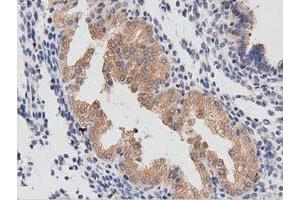 Immunohistochemical staining of paraffin-embedded Carcinoma of Human prostate tissue using anti-PTPRE mouse monoclonal antibody.