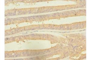Immunohistochemistry of paraffin-embedded human endometrial cancer using ABIN7142540 at dilution of 1:100