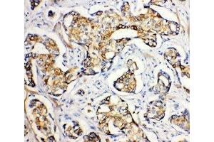 Anti-SERCA2 ATPase antibody, IHC(P) IHC(P): Human Mammary Cancer Tissue (ATP2A2 antibody  (Middle Region))