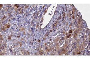 ABIN6276889 at 1/100 staining Human liver cancer tissue by IHC-P.