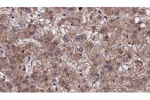 ABIN6273971 at 1/100 staining Human liver cancer tissue by IHC-P. (OR1J2/1N2 antibody)
