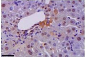 Representative immunohistochemistry of HM GB1 (brown) in liver during hepatitis. (HMGB1 antibody)