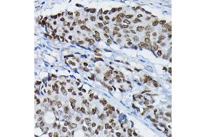 Immunohistochemistry of paraffin-embedded human colon carcinoma using S Rabbit pAb (ABIN7270154) at dilution of 1:100 (40x lens). (SATB2 antibody  (AA 540-620))