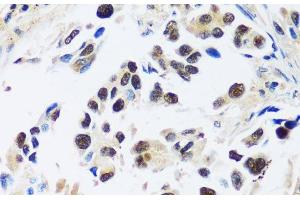 Immunohistochemistry of paraffin-embedded Human lung cancer using ASCL4 Polyclonal Antibody at dilution of 1:100 (40x lens). (ASCL4 antibody)