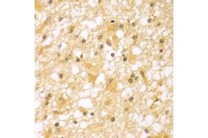 Immunohistochemistry of paraffin-embedded human brain cancer using PAK6 antibody at dilution of 1:100 (40x lens).