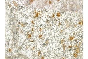 ABIN6257055 and ABIN6274988 at 1/100 staining human thyroid carcinoma by IHC-P.