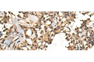 Immunohistochemistry of paraffin-embedded Human ovarian cancer tissue using CASK Polyclonal Antibody at dilution of 1:65(x200) (CASK antibody)