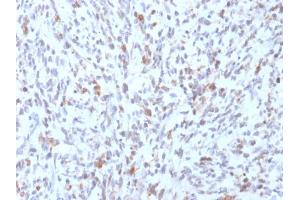 Formalin-fixed, paraffin-embedded human Rhabdomyosarcoma stained with MyoD1 Mouse Recombinant Monoclonal Antibody (rMYD712).
