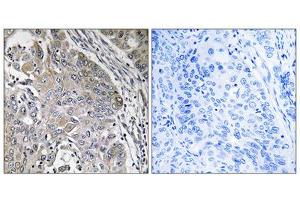 Immunohistochemistry analysis of paraffin-embedded human lung carcinoma tissue using SPINK6 antibody. (SPINK6 antibody  (Internal Region))